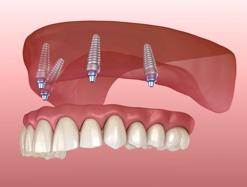 All-on-4 Dental Implants