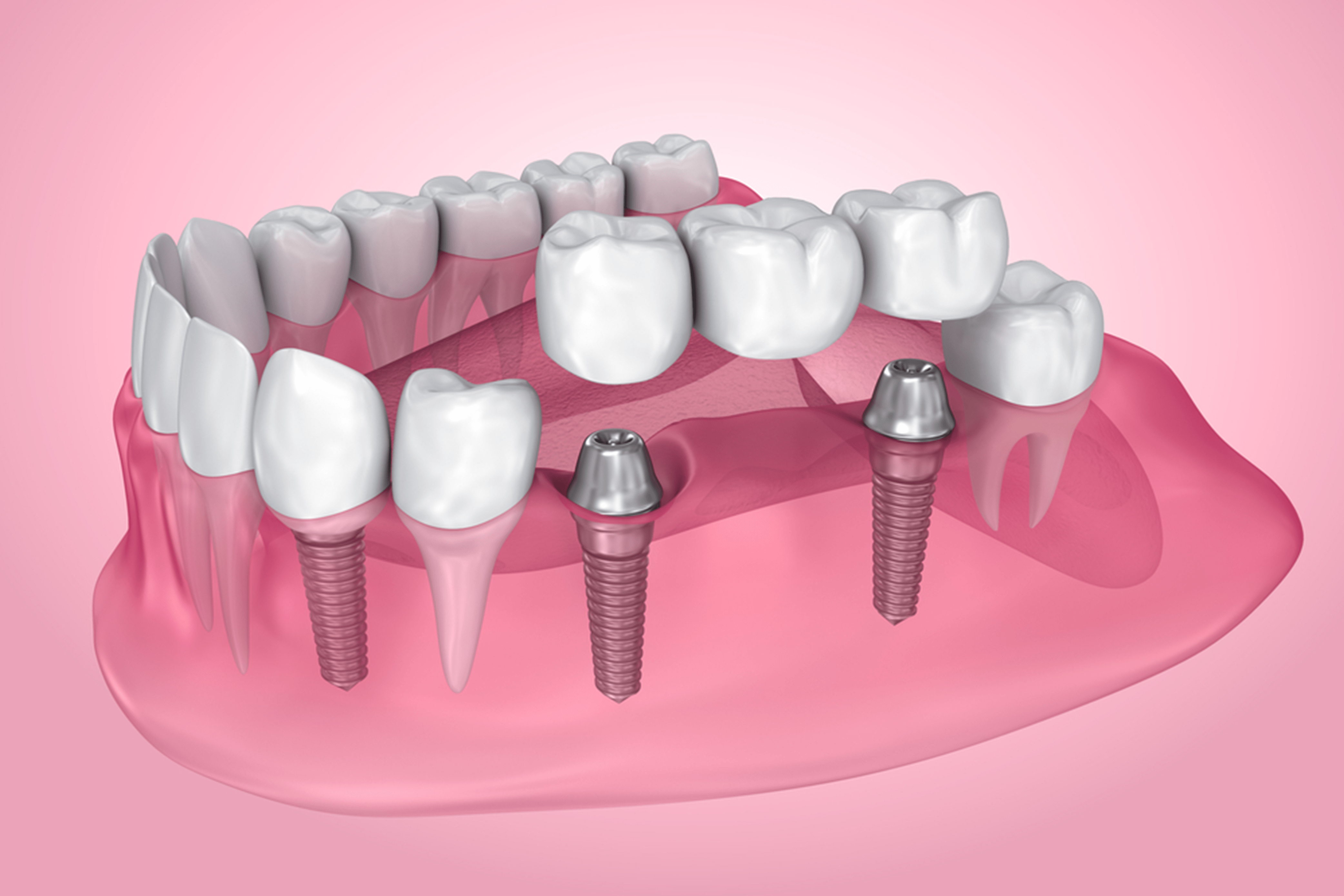 Bridges on Implants