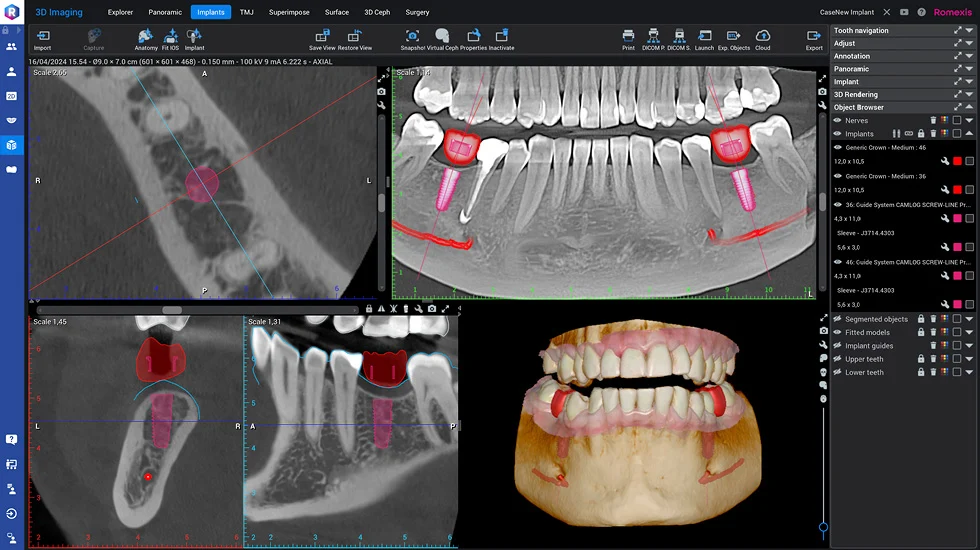 3D Guided Surgery