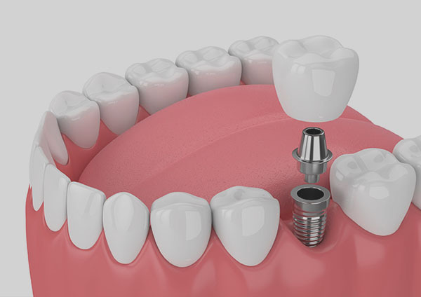 Single Dental Implant